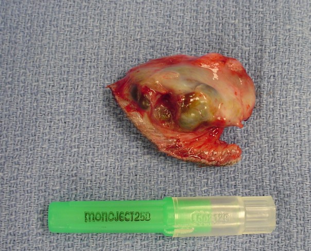 BENIGN sweat gland cyst in the tail of a 9 year old Labrador